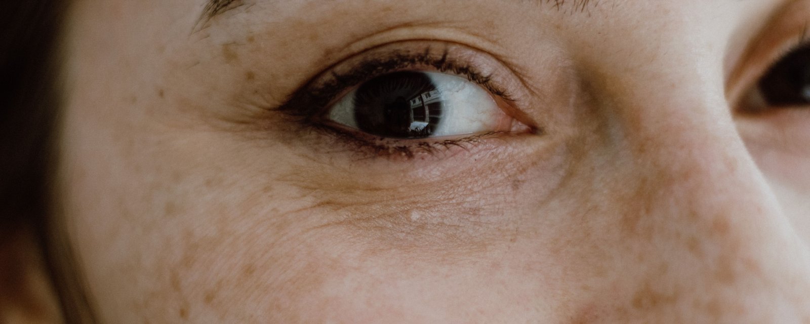 A woman's eye and cheek with scattered brown sun freckles and fine lines