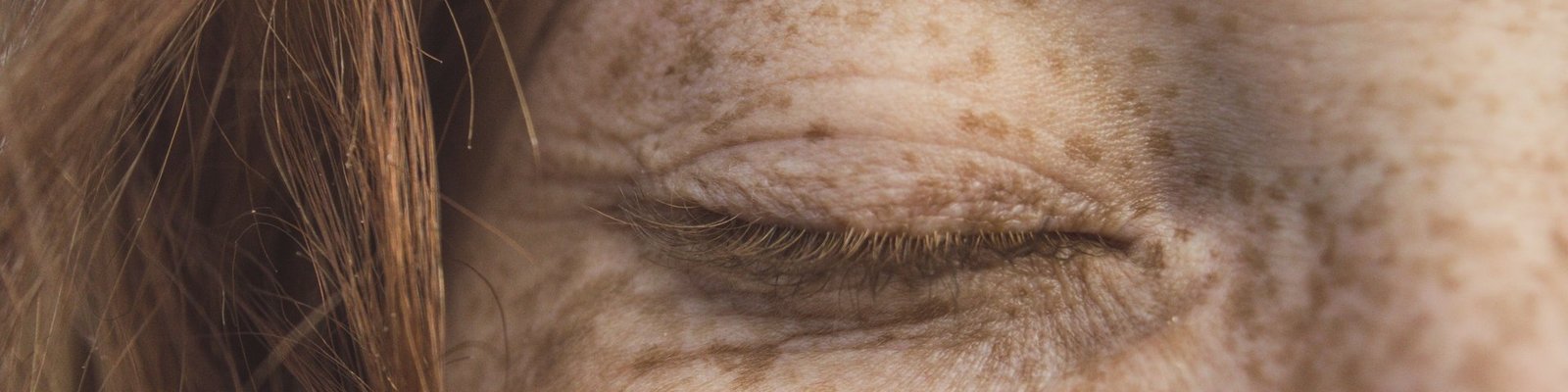 Close-up of a woman's closed eye and cheek covered in sun spots and freckles